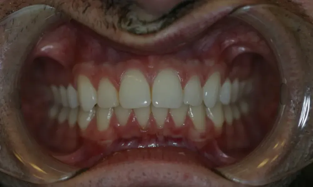 Clinical photo from Chad's cosmetic jaw surgery case